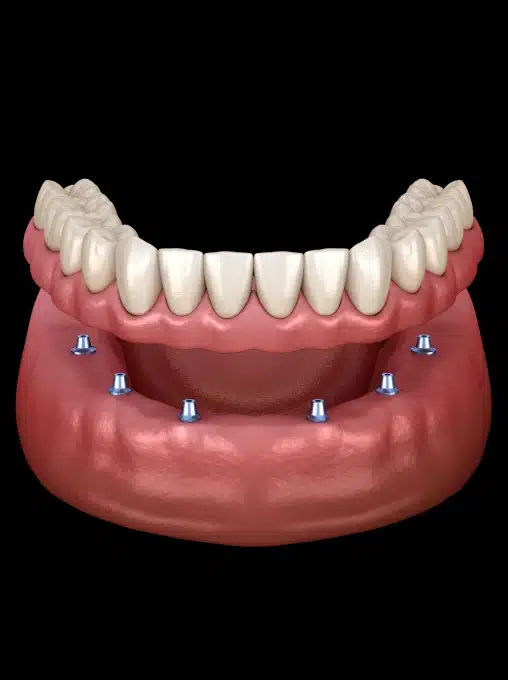 Implant-supported denture model